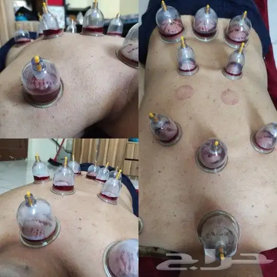 متخصص حجامه  منزليه خبره اكثر 5 سنوات 2