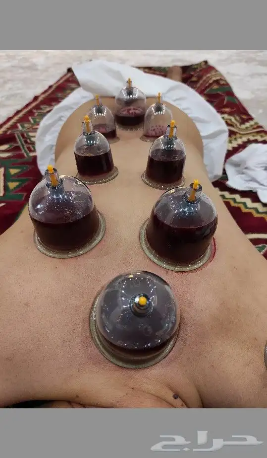 اخصائي حجامه زيارات منزليه 4