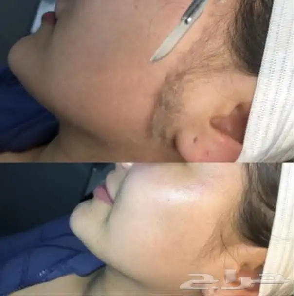 ميكروبليدنج الحواجب وفرد الشعر وتنظيف البشره الطبي 7