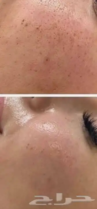 جلسات نضارة البشرة 4