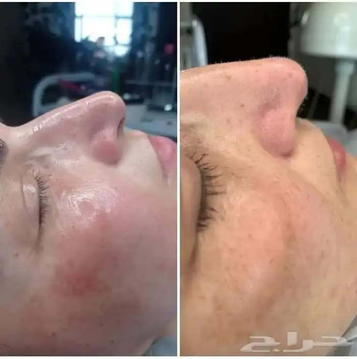 جلسات نضارة البشرة 7
