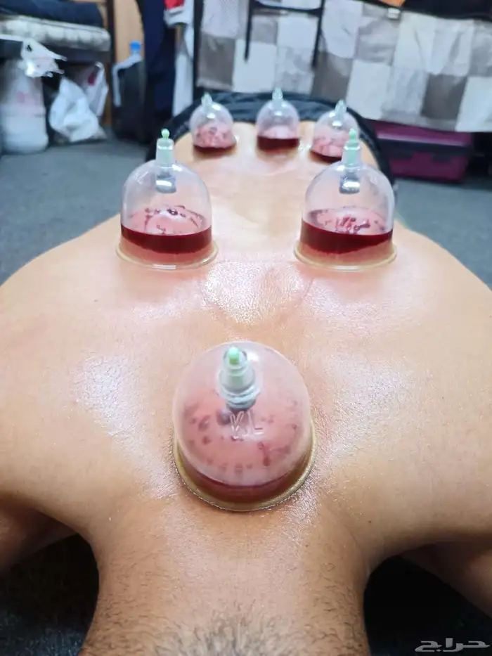 متخصص حجامة منزلية خبرة اكثر من 5 سنوات 3