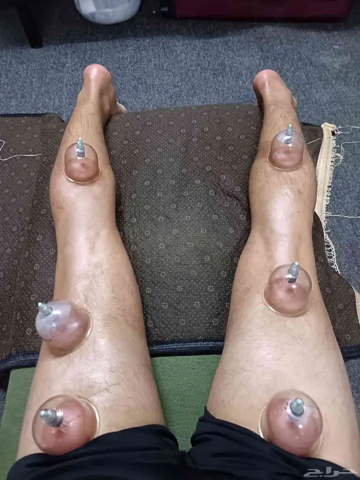 متخصص حجامة منزلية خبرة اكثر من 5 سنوات 4