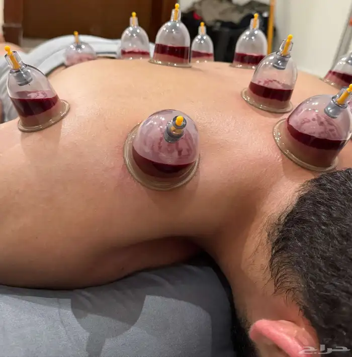 متخصص حجامة. منزليه خبره اكثر من 5 سنوات 2