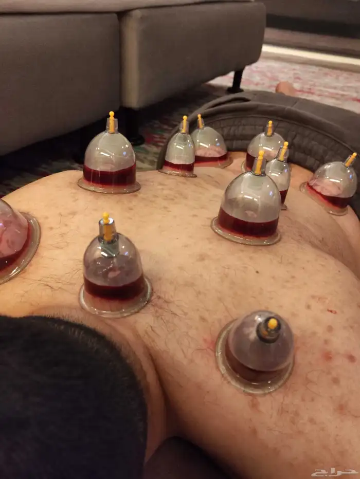 متخصص حجامة. منزليه خبره اكثر من 5 سنوات 5