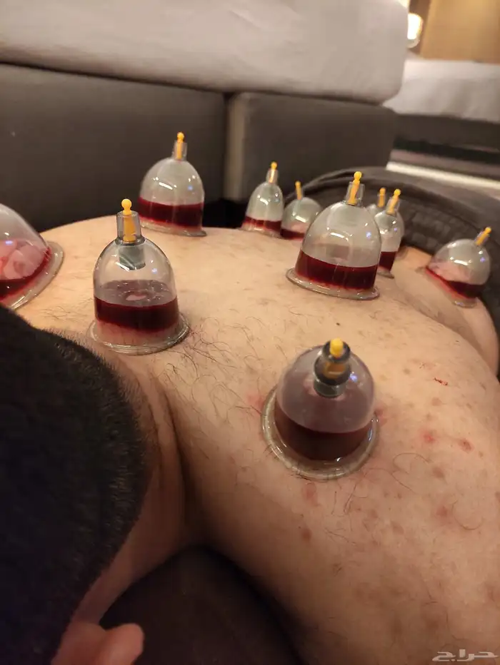 متخصص حجامة. منزليه خبره اكثر من 5 سنوات 3