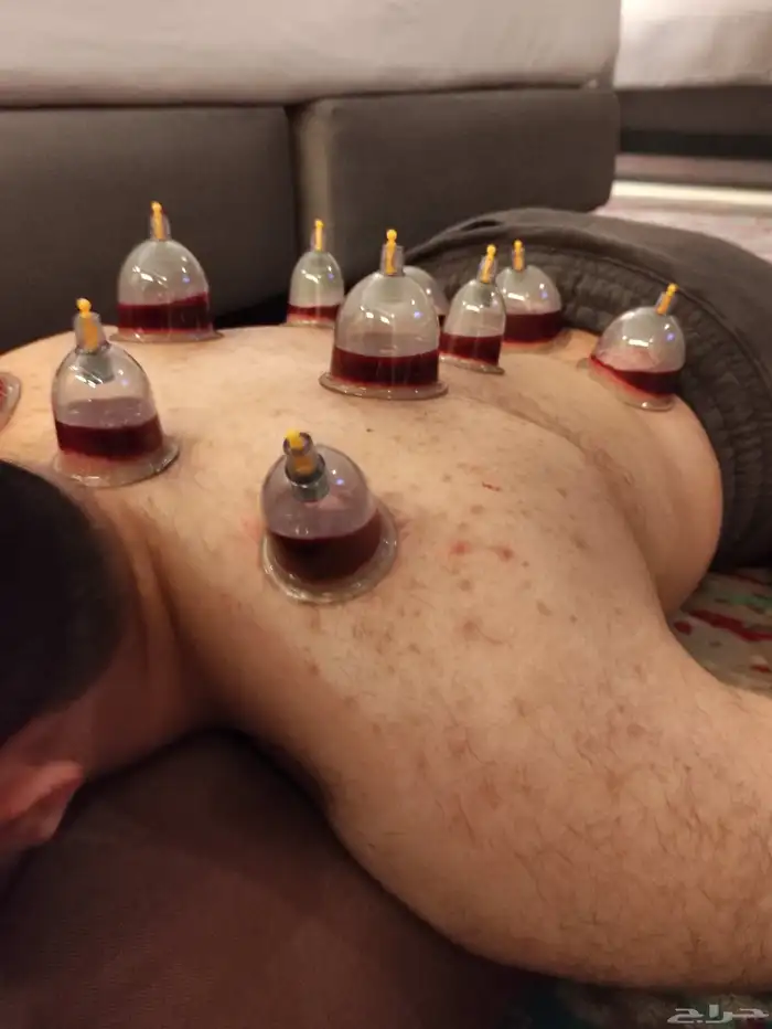 متخصص حجامة. منزليه خبره اكثر من 5 سنوات 4