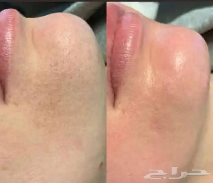 فرد الشعر ميكروبليدنج تركيب رموش 9