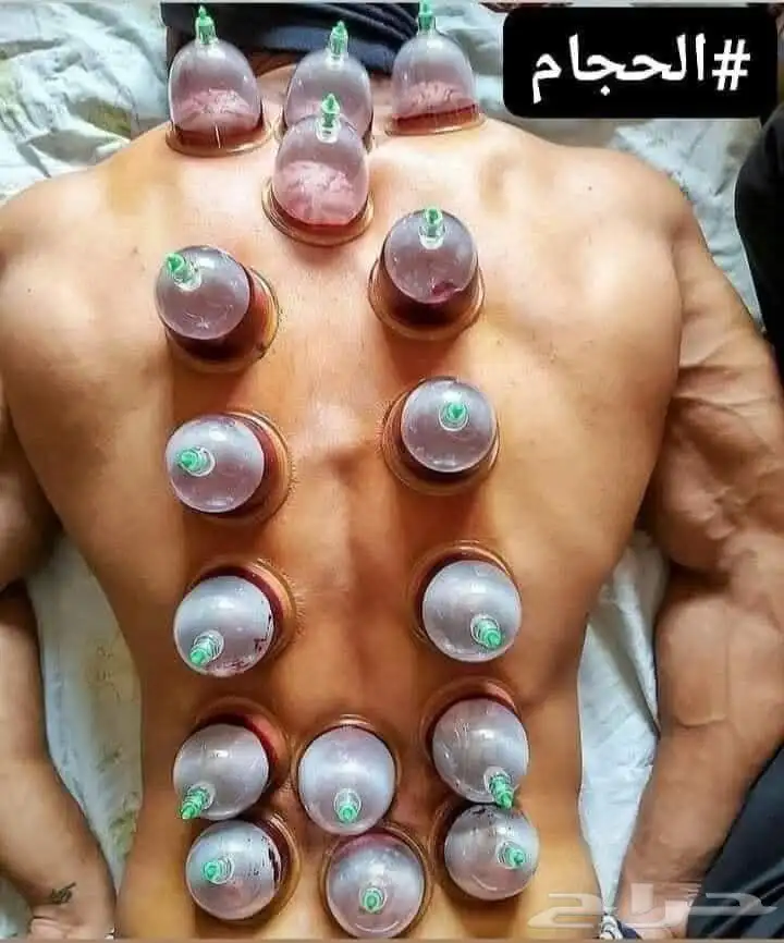 حجام مصري متخصص في عمل الحجامة 0