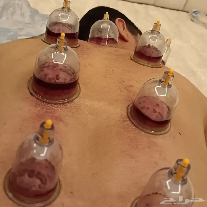 متخصص حجامة منزلية خبرة اكثر من 5 أعوام 2