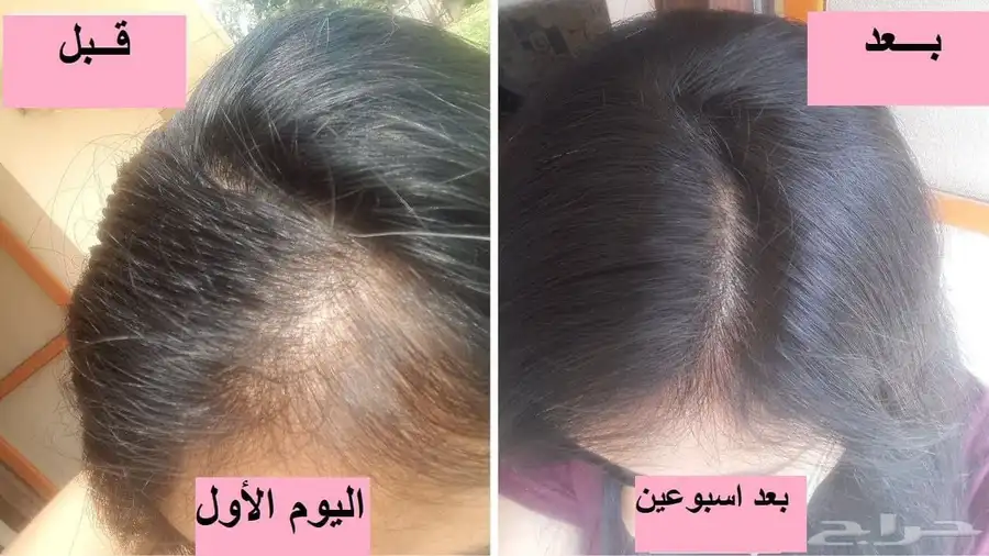 للتخلص من تساقط الشعر index