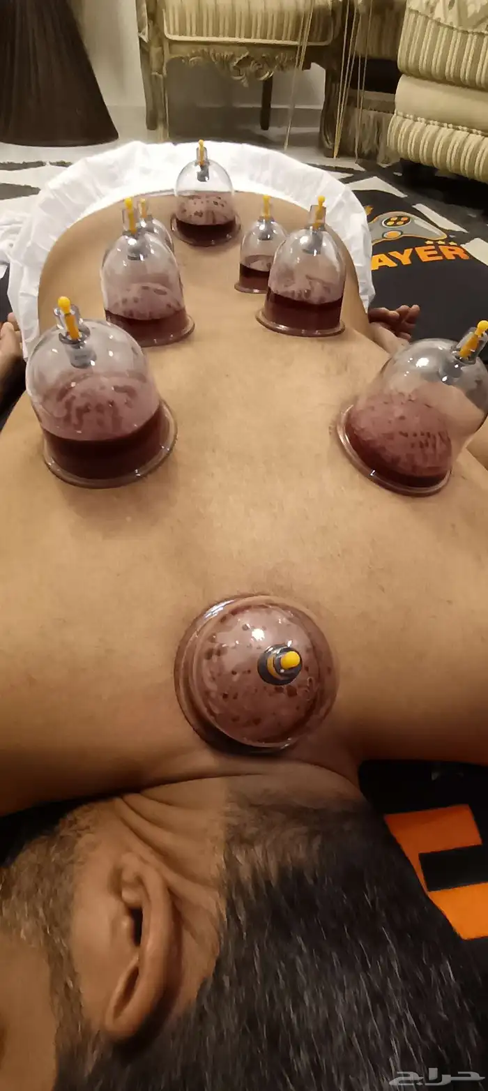 متخصص حجامة منزلية خبرة اكثر من 5 سنوات 0