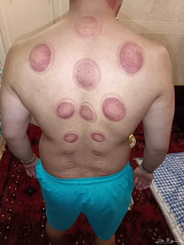 متخصص حجامة منزلية خبرة اكثر من 5 سنوات 8