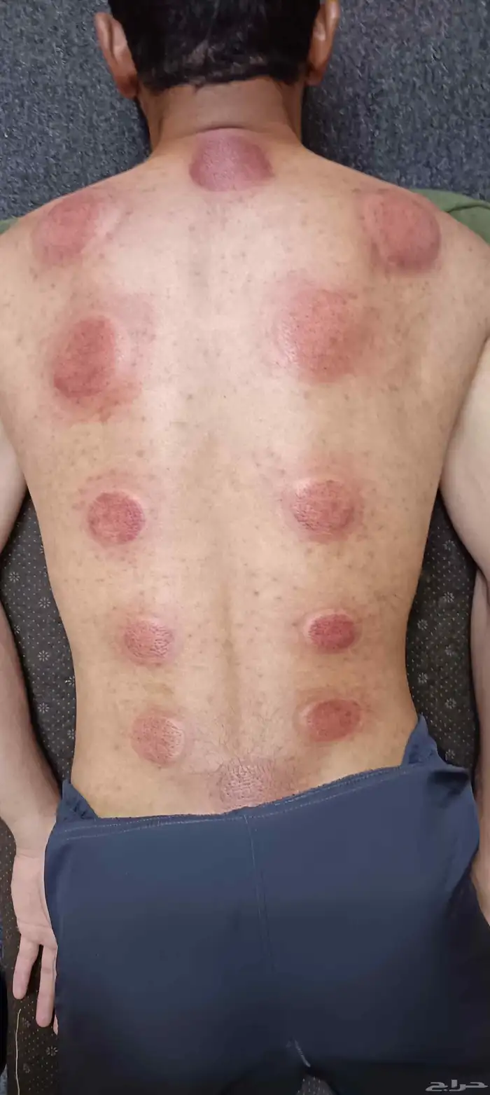 متخصص حجامة منزلية خبرة اكثر من 5 سنوات 2