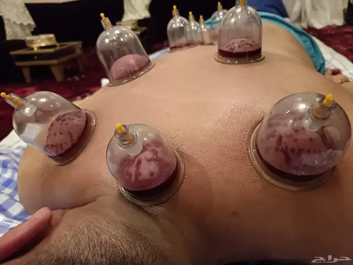 متخصص حجامة منزلية خبرة اكثر من 5 سنوات 9