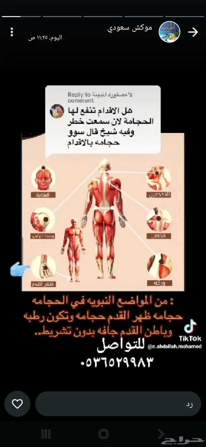 حجامه منزليه بجده علي احدث الطرق والادوات والتشريط استفسرو 2