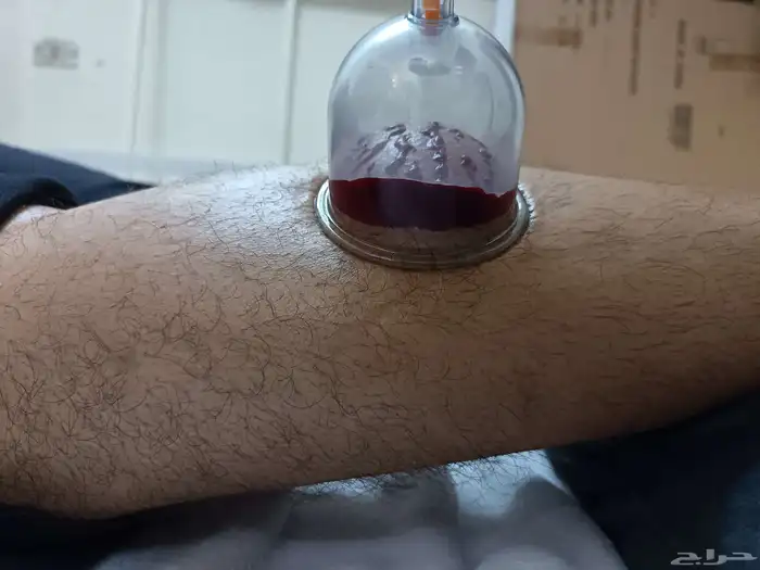 متخصص حجامة منزلية خبرة اكثر من 5 أعوام 5
