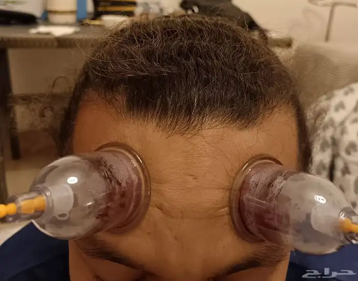 متخصص حجامة منزلية خبرة اكثر من 5 أعوام 6