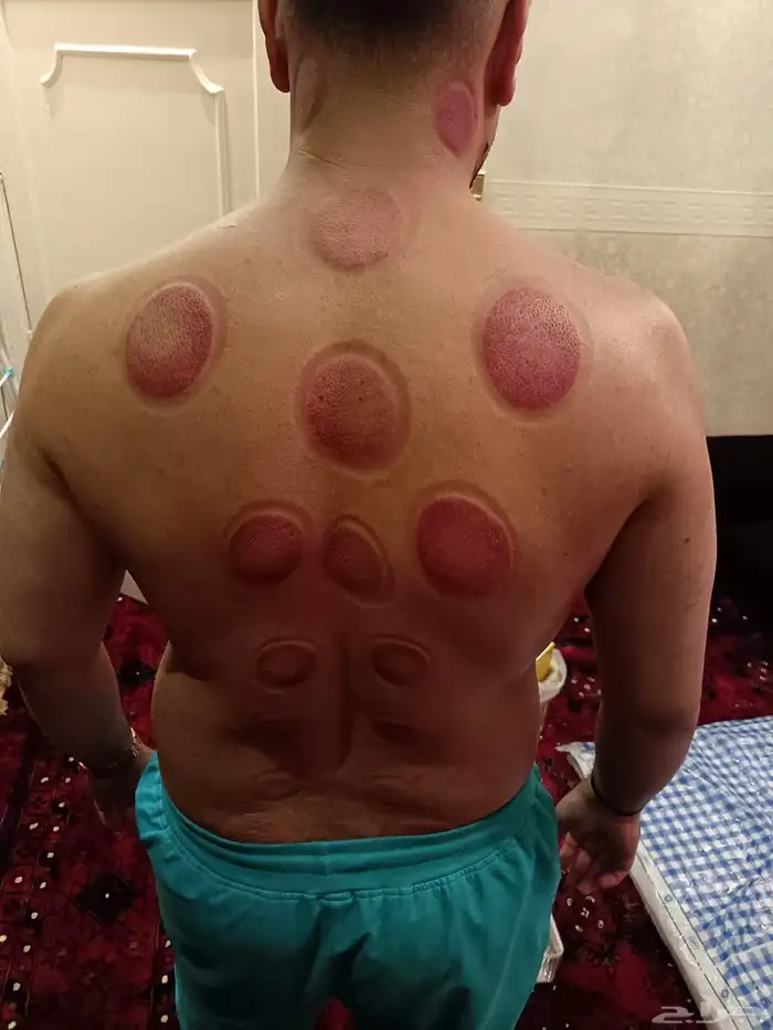متخصص حجامة منزلية خبرة اكثر من 5 أعوام 9