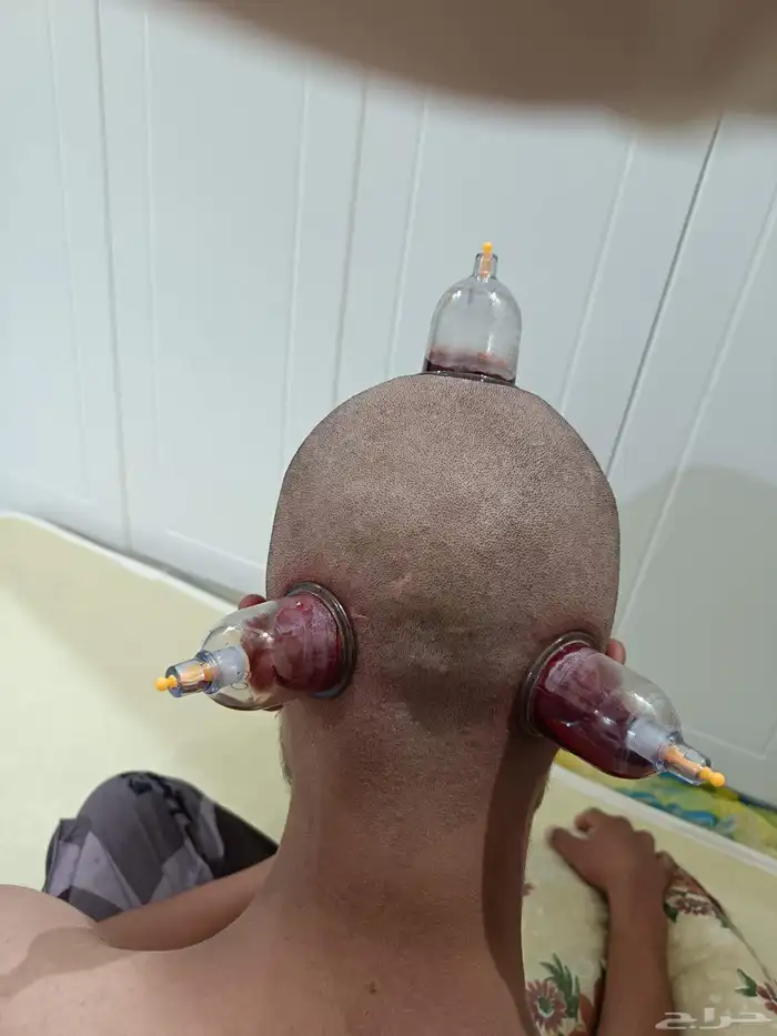 متخصص حجامة منزلية خبرة اكثر من 5 أعوام 8