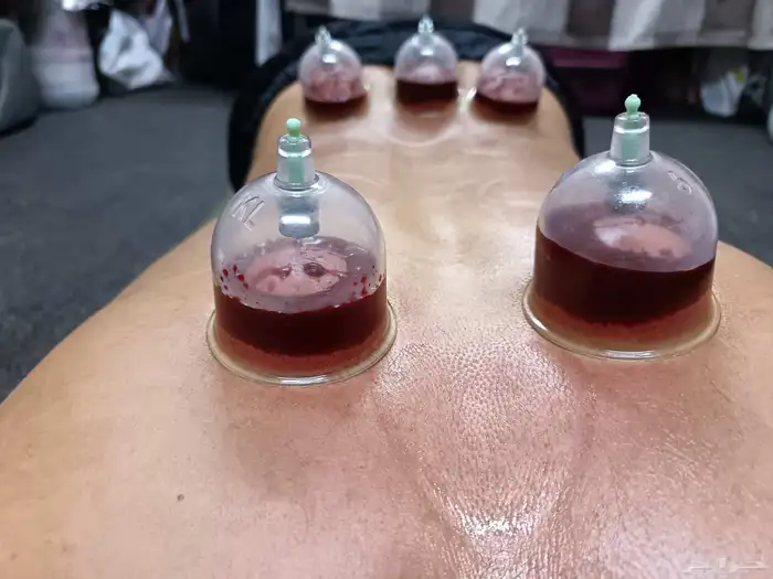 متخصص حجامة منزلية خبرة اكثر من 5 أعوام 1