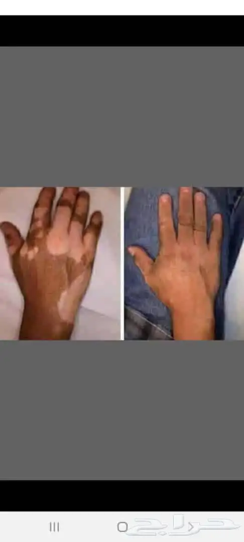 للتخلص من البهاق بأفضل المنتجات الطبيعيه خالي كورتيزون 0
