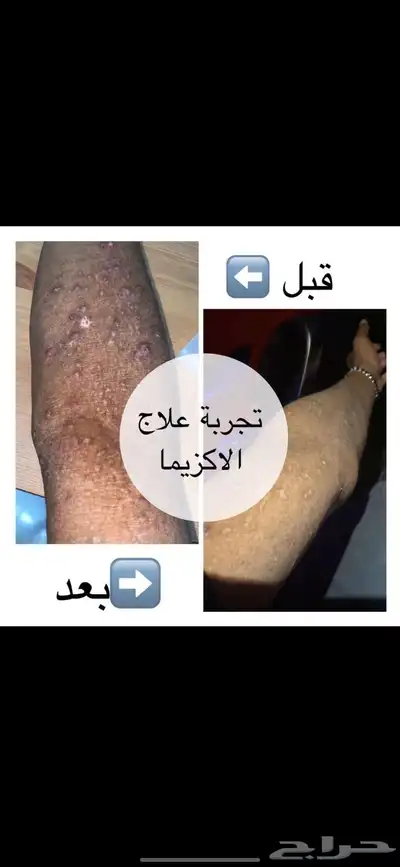 منتج للإكزيما و الصدفية 1