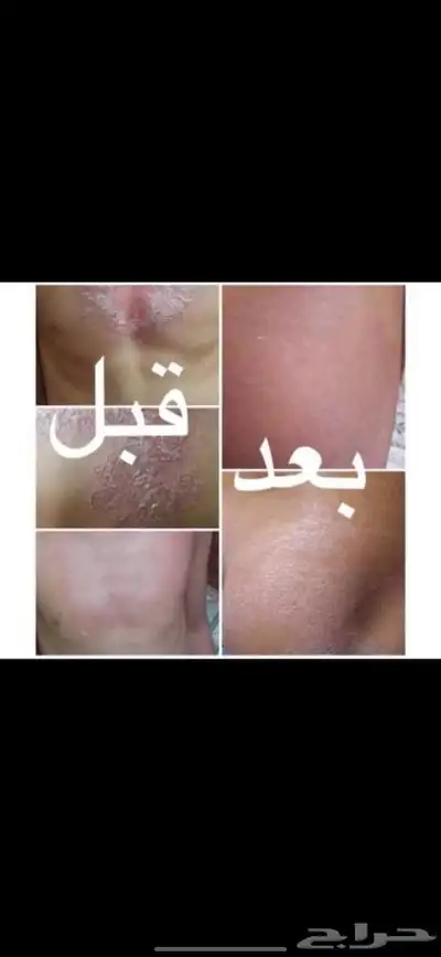منتج للإكزيما و الصدفية 0