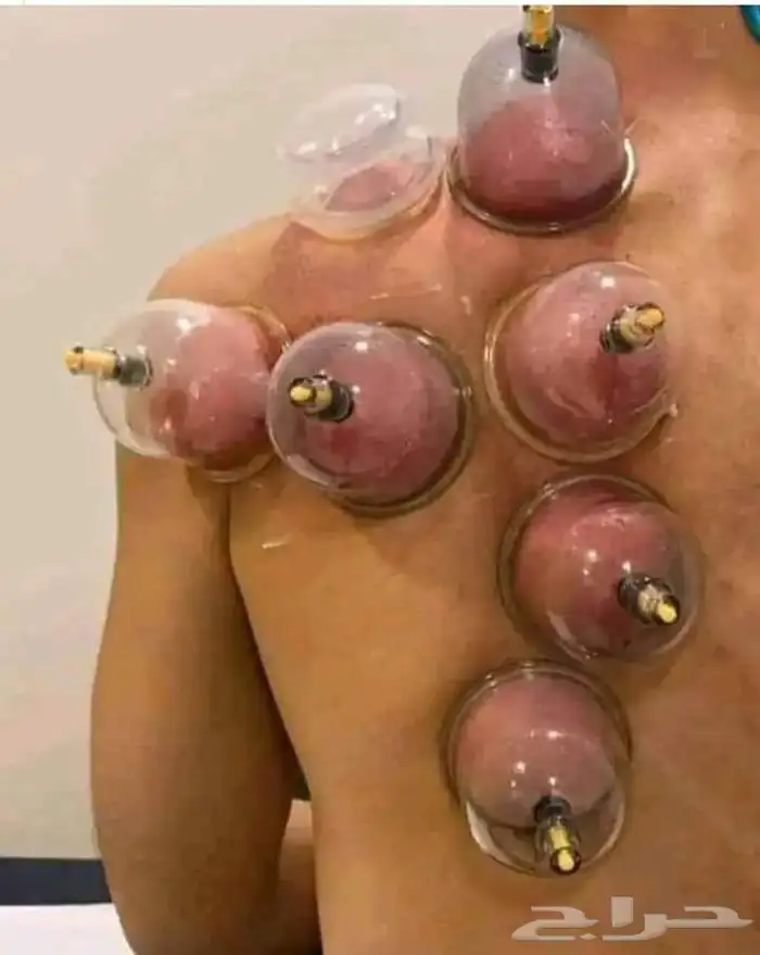 حجامه دكتور صبحي وعلاج طبيعي منزلي (محافظة رابغ) 1