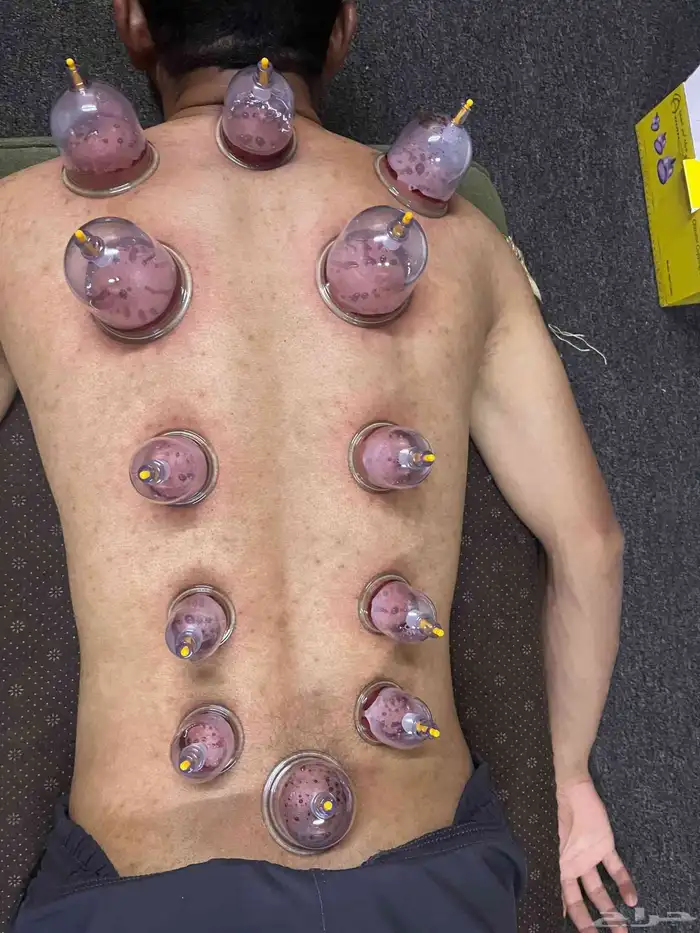 متخصص حجامة منزلية خبرة اكثر من 5 سنوات 8