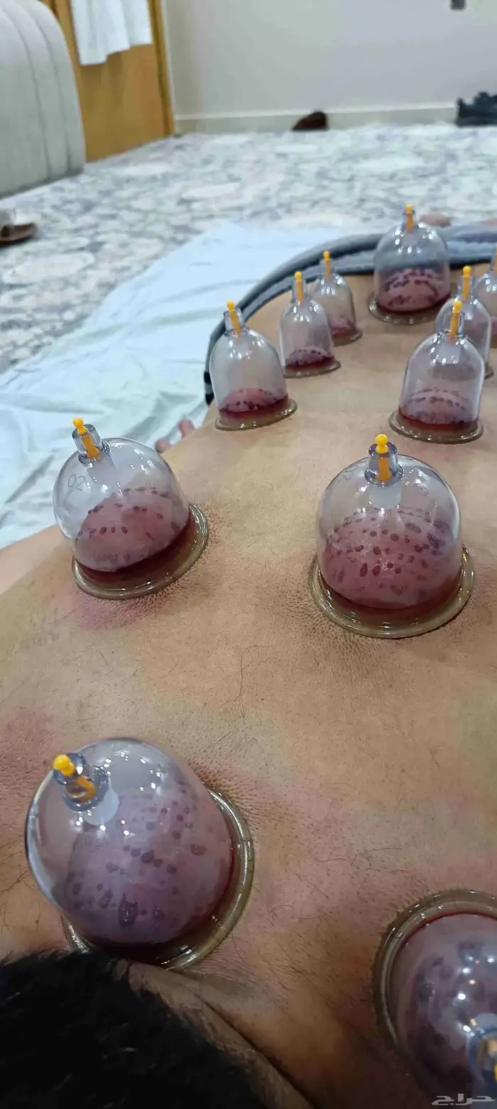 متخصص حجامة منزلية خبرة اكثر من 5 سنوات 9