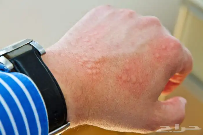 علاج الأكزيما بشكل نهائي  تخلص من الحكة والتهيج 3