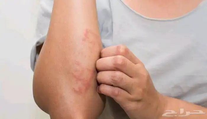 علاج الأكزيما بشكل نهائي  تخلص من الحكة والتهيج 2