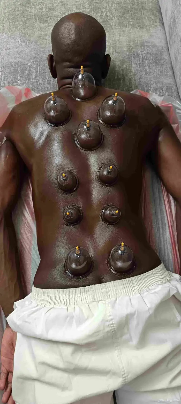 متخصص حجامة منزلية خبرة اكثر من 5 سنوات 5