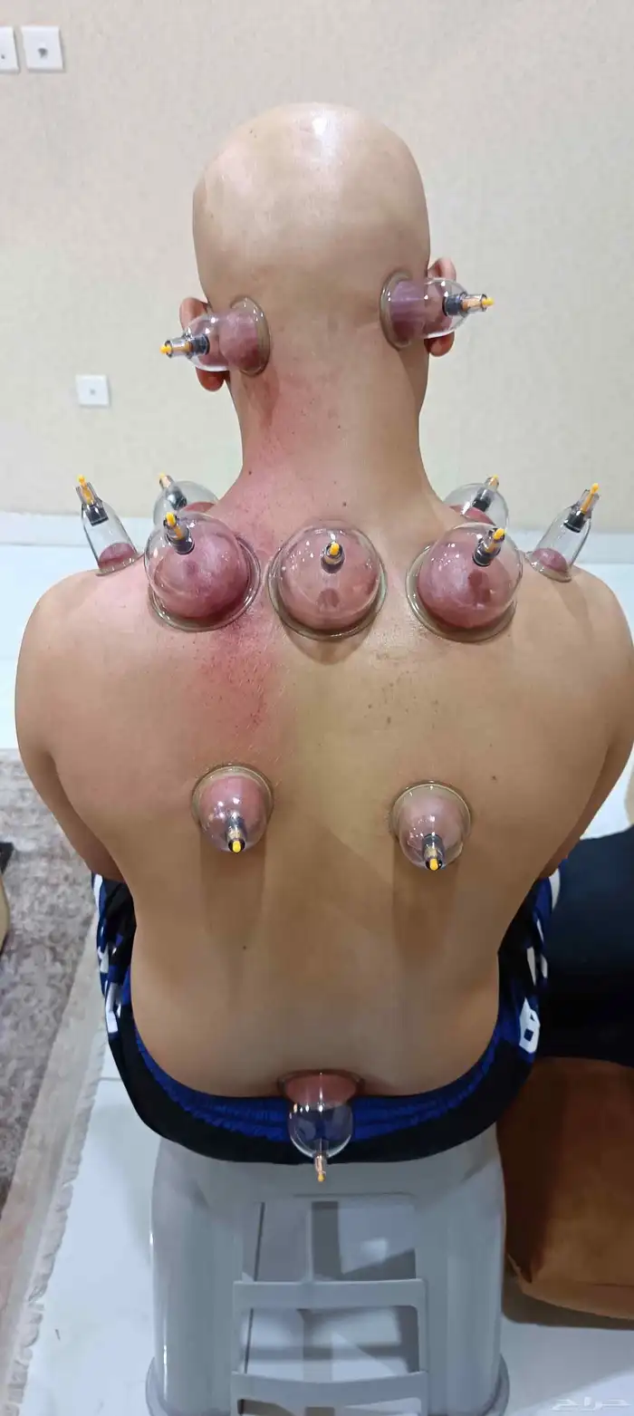 متخصص حجامة منزلية خبرة اكثر من 5 سنوات 8