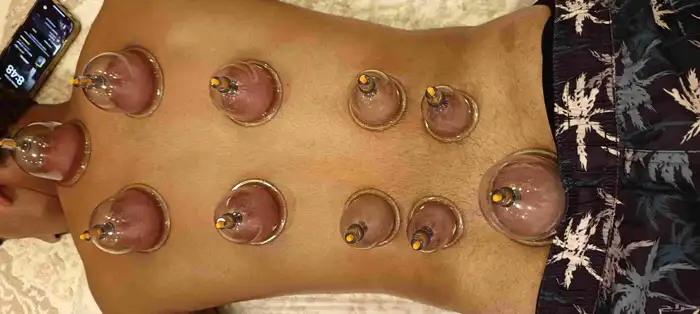 متخصص حجامة منزلية خبرة اكثر من 5 سنوات 7