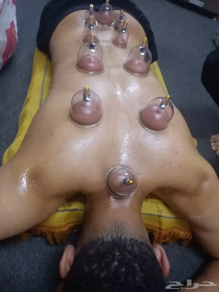 متخصص حجامة منزلية خبرة اكثر من 5 سنوات 1