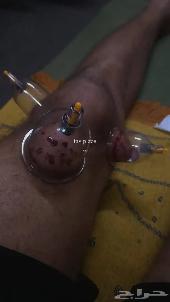 متخصص حجامة منزلية خبرة اكثر من 5 سنوات 6