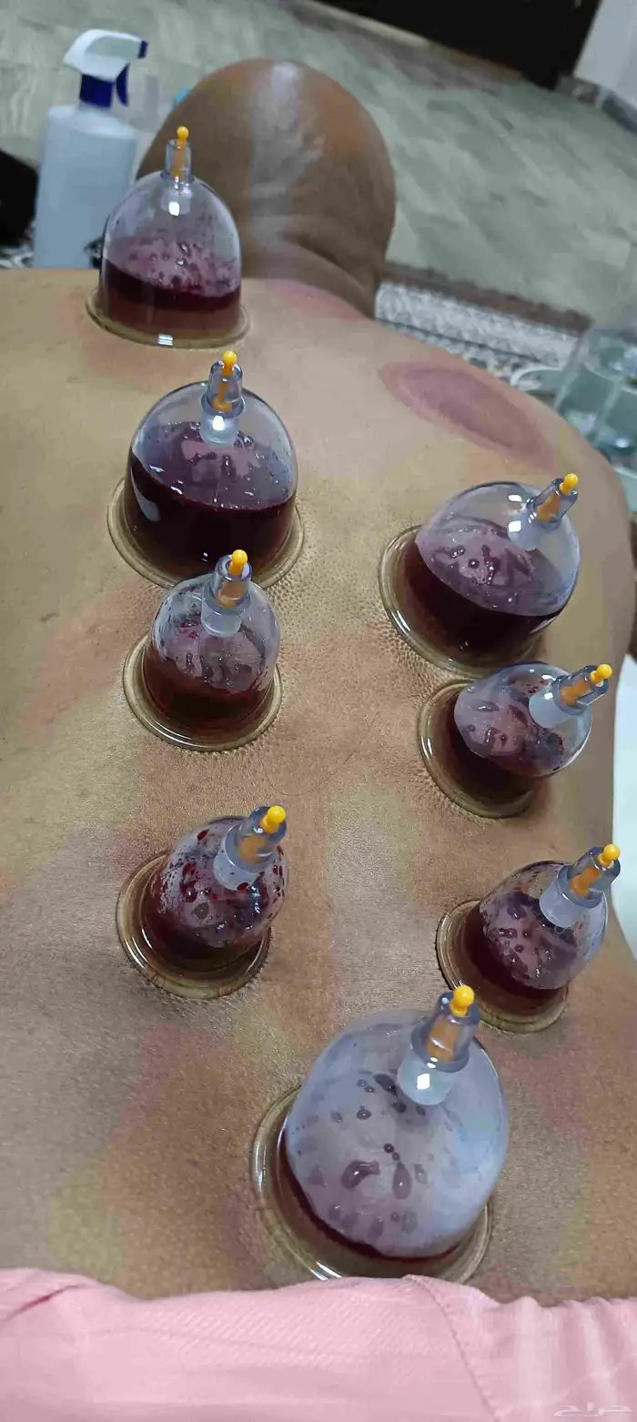 متخصص حجامة منزلية خبرة اكثر من 5 سنوات 3