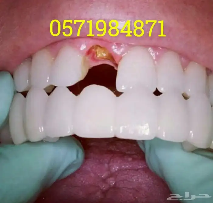 هوليود سمايل المتحركة 1