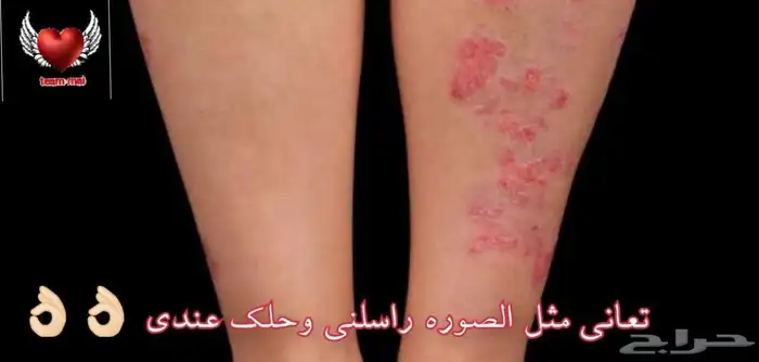 مجموع الاكزيما 0
