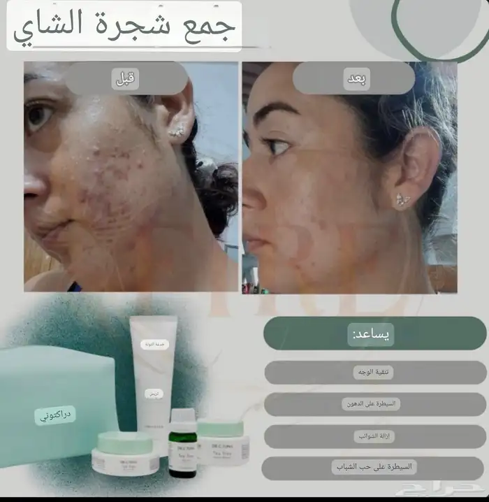 مجموعة علاج حب الشباب والحبوب الهرمونية.. طبية تركية 0