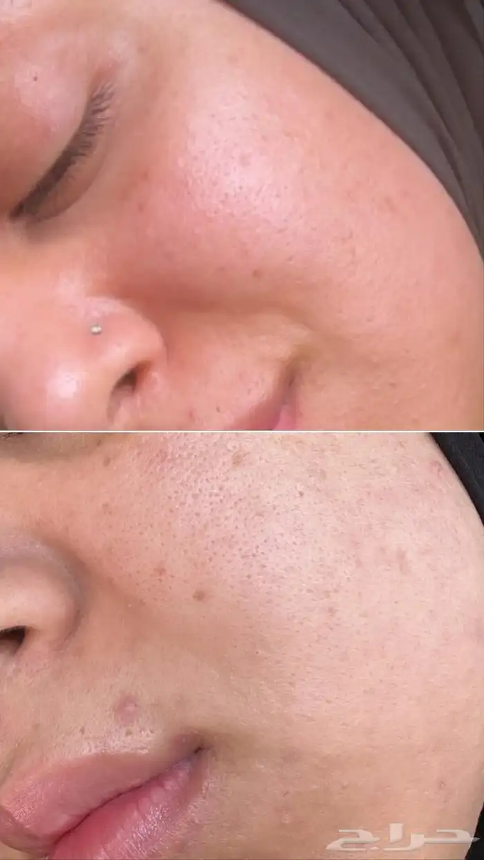 مجموعة علاج حب الشباب والحبوب الهرمونية.. طبية تركية 7